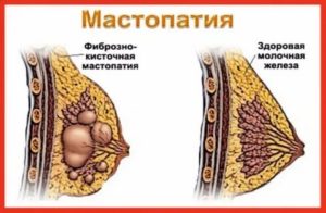 Могут ли быть уплотнения в молочной железе при климаксе