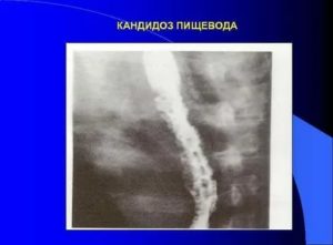 Кандидоз пищевода при спиде