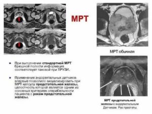 Анатомия предстательной железы по мрт