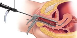 Гистероскопия матки при кровотечении