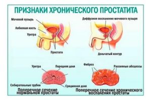 Чем отличается хронический от острого простатита