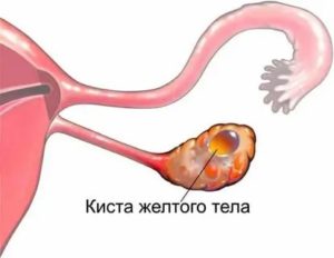 Что такое желтое тело с кистозным компонентом