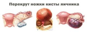 Можно ли вылечить кисту яичника заговорами