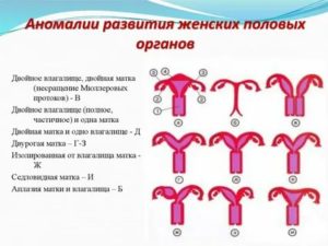 Диагностики аномалий развития женских половых органов