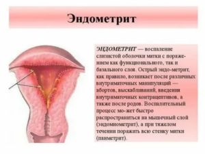 Беременность после лечения эндометрита и эндометриоза