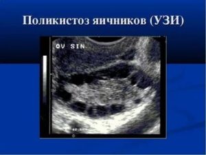 Может ли одно узи показать поликистоз яичников