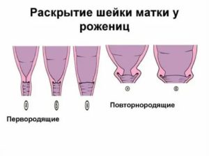 Влияние дюфастона на раскрытие шейки матки