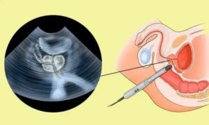 Диффузные и очаговые изменения паренхимы предстательной железы что это такое