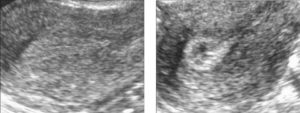 Гипоэхогенное образование в матке по узи