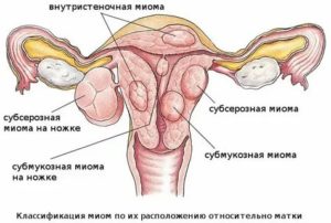 Цимицифуга при миоме и эндометриозе