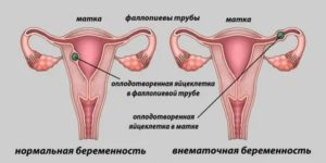 Что если через неделю пошли месячные второй раз за месяц