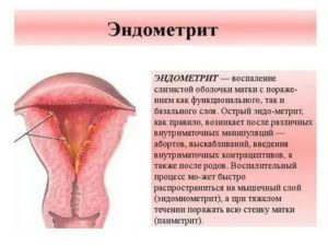 Диагностика хронического воспаления матки