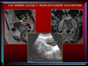 Опухоль с инфильтрацией параметрия