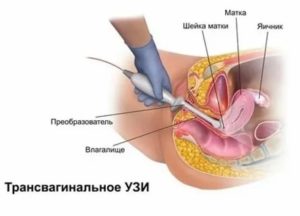 Чем вагинальное узи отличается от трансабдоминального