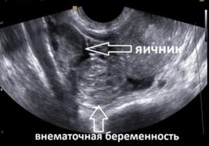 Могут ли на узи по яичникам определить беременность