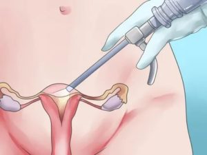 Выскабливание матки при миоме и эндометриозе