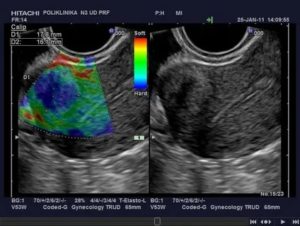 Узи матки и придатков с эластографией что это