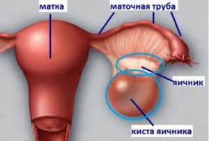 Что такое киста в яичниках женских половых органах