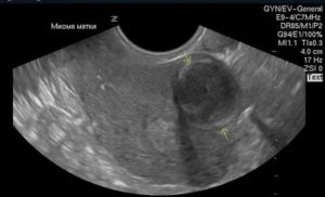 Микрокальцинаты при узи матки