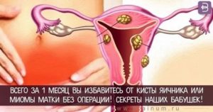 Как вылечить народными средствами миому матки и кисту яичника