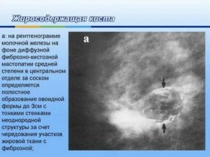 Рассасываются ли кисты в молочной железе при климаксе