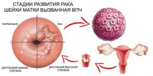 Какими препаратами лечить кондиломы на шейке матки