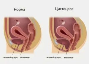 Препараты для лечения цистоцеле
