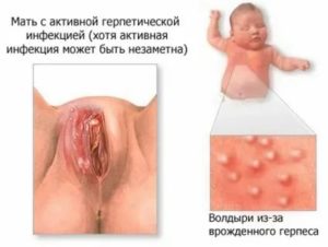 Генитальный герпес и молочница могут быть одновременно