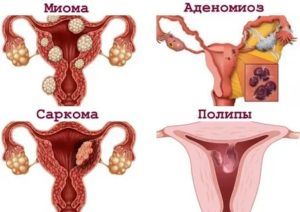 Эндометриоз аденомиоз миому полипы эндометрия