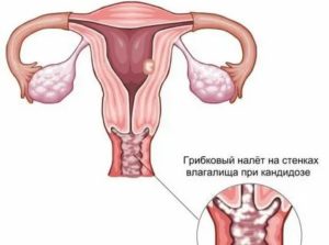 Может ли из за молочницы подниматься высокая температура