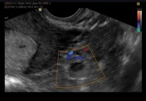 Яичниковая внематочная беременность на узи