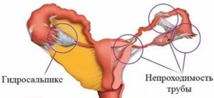 Женское бесплодие трубного происхождения что это такое