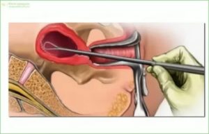 Гистероскопия с раздельно-диагностическим выскабливанием эндометрия
