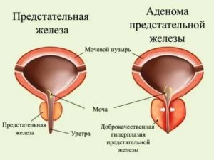 Диагноз предстательная железа susp