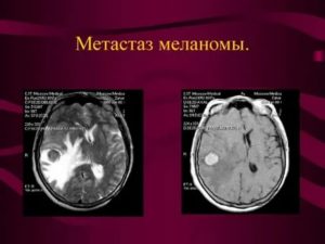 Метастазы в лимфоузлах паховой области прогноз