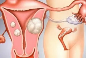 Можно ли при эндометриозе матки крутить обруч