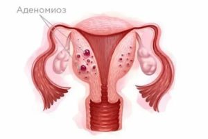 Эндометриоз культи шейки матки симптомы и