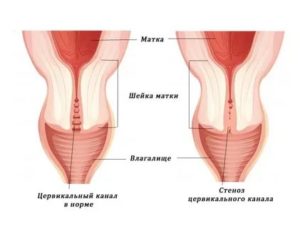 Цервикальный канал сомкнут это бесплодие