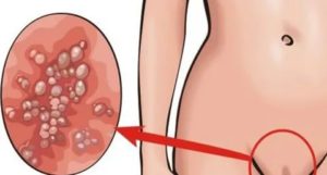 Впч и хроническая молочница