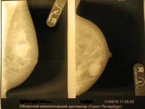 Можно ли при кисте молочной железы заниматься спортом