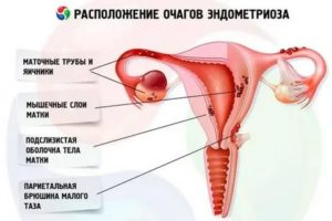 Беременность при эндометриозе лечение жанином