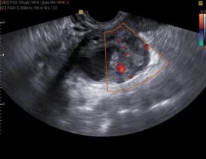 На узи объемное образование правого яичника