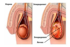 Опухоль семенного канатика у мужчин симптомы лечение