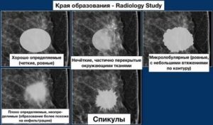 Опухоль в молочной железе с лучистыми контурами