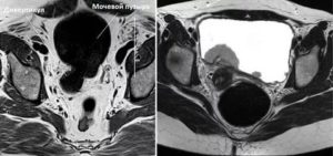Мрт мочевого пузыря. Мрт мочевого пузыря с контрастированием. Дивертикул мочевого мрт. Снимки мрт мочевого пузыря.