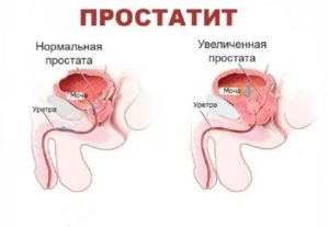 Что будет если в 18 лет заболеть простатитом