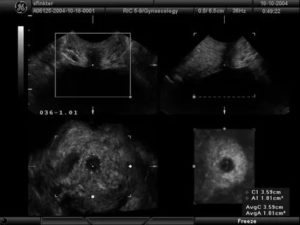 Узи при пролапсе гениталий