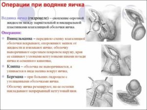 Водянка яичка мочегонные препараты