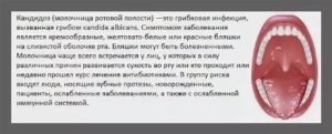 Молочница у мужчин горло как лечить