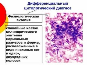 Цитологическая картина эктопии шейки матки что это такое